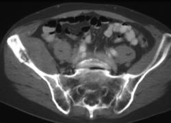 Metastases Right Iliac Wing - CTisus CT Scan