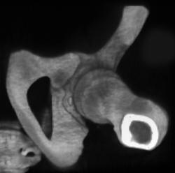 Intra-articular Joint Fragment - CTisus CT Scan