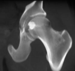 Gun Shot to Left Acetabulum - CTisus CT Scan