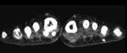 Foreign Body Left Foot - CTisus CT Scan