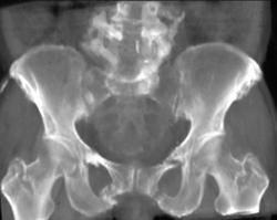 Multiple Pelvic Fractures - CTisus CT Scan