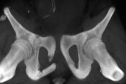 Pelvic Fracture - CTisus CT Scan