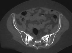 Stress Fracture Sacrum - CTisus CT Scan