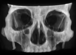 Orbital Fracture (right) - CTisus CT Scan