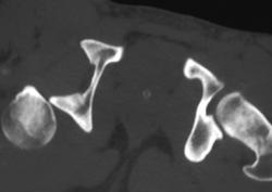 Right Hip Dislocation - CTisus CT Scan