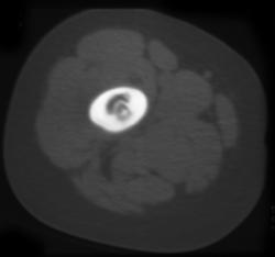 Osteoid Osteoma - CTisus CT Scan