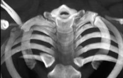 Non Union 1st Rib Fractures - CTisus CT Scan