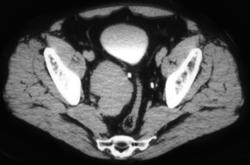 Neurofibroma (right Side) - CTisus CT Scan