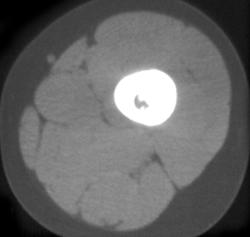 Osteoid Osteoma - CTisus CT Scan