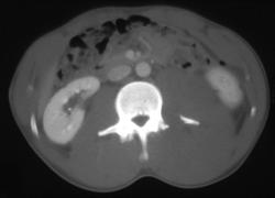 Transverse Process Fracture With Hematoma - CTisus CT Scan