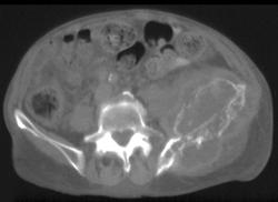 Metastases to Bone - CTisus CT Scan