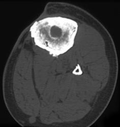 Healing Fracture - CTisus CT Scan