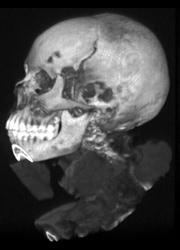 3D of Ampato Mummy With Skull Fracture - Incan Mummy - CTisus CT Scan