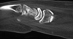 Impacted Radial Fracture - CTisus CT Scan