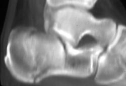 Calcaneal Fracture - CTisus CT Scan