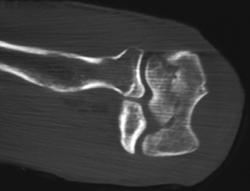 Humerus Fracture - CTisus CT Scan