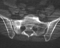 Sacral Metastases - CTisus CT Scan