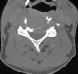 Metastases to C-spine - CTisus CT Scan