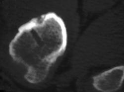 Prior Removal of Osteoid Osteoma - CTisus CT Scan