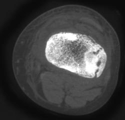 Tibial Plateau Fracture - CTisus CT Scan