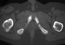 Osteoid Osteoma (recurrent) - CTisus CT Scan