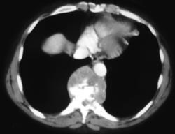 Paraspinal Abscess (TB) - CTisus CT Scan