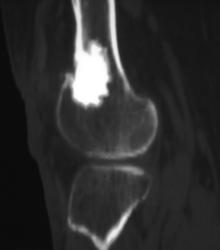 Giant Osteoma in Femur - CTisus CT Scan