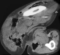 Necrotizing Fasciitis - CTisus CT Scan