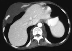 Neurofibromatosis - CTisus CT Scan