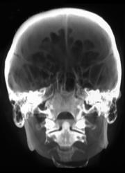 3D of the Odontoid - CTisus CT Scan