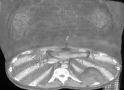 Subcutaneous Nodules - CTisus CT Scan