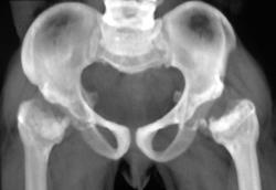 Dysplastic Hips- Dwarfism - CTisus CT Scan