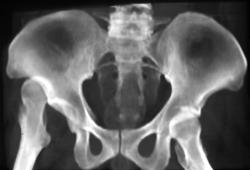 Congenital Hip Dislocation - CTisus CT Scan