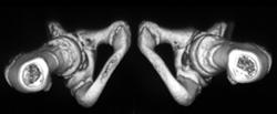 Shaded Surface 3D of Pelvis - CTisus CT Scan