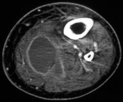 Calf Abscesses - CTisus CT Scan