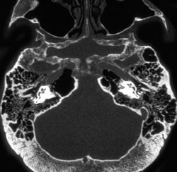 Thickened Cortex - CTisus CT Scan