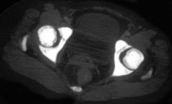 Sclerotic Bones Due to Myelofibritis - CTisus CT Scan