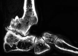 Fusion of Talus and Tibia Due to Prior Trauma - CTisus CT Scan