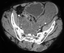 Chordoma - CTisus CT Scan