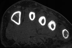 Stress Fracture - CTisus CT Scan