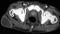 Bleed in Right Psoas Muscle - CTisus CT Scan