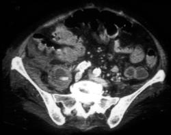 Bleed Extends From Psoas Into Right Iliacus Muscle - CTisus CT Scan