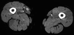 Muscle Abscesses - CTisus CT Scan