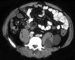 Neurofibromatosis - CTisus CT Scan