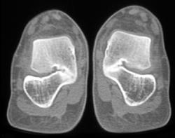 Tarsal Coalition - CTisus CT Scan