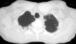 Radiation Induced Sarcoma of the Clavicle - CTisus CT Scan