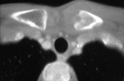 Osteomyelitis Lt S/c Joint - CTisus CT Scan