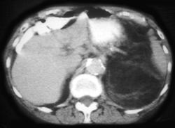 Liposarcoma - CTisus CT Scan