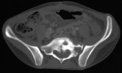 Ewing Sarcoma - CTisus CT Scan