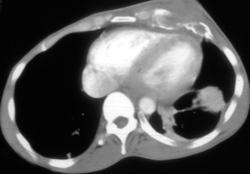 Chest Wall Abscess; Intravenous Drug Abuse (IVDA) - CTisus CT Scan